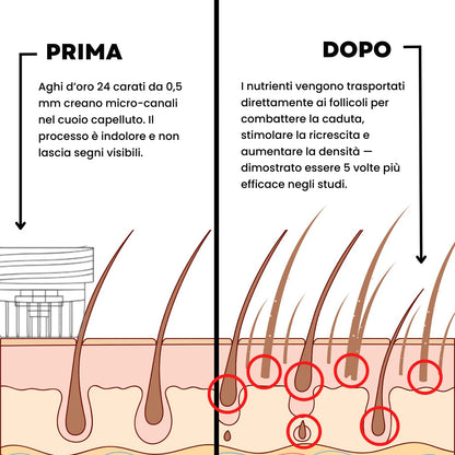 ApexInfuse™ Sistema di Ricrescita dei Capelli