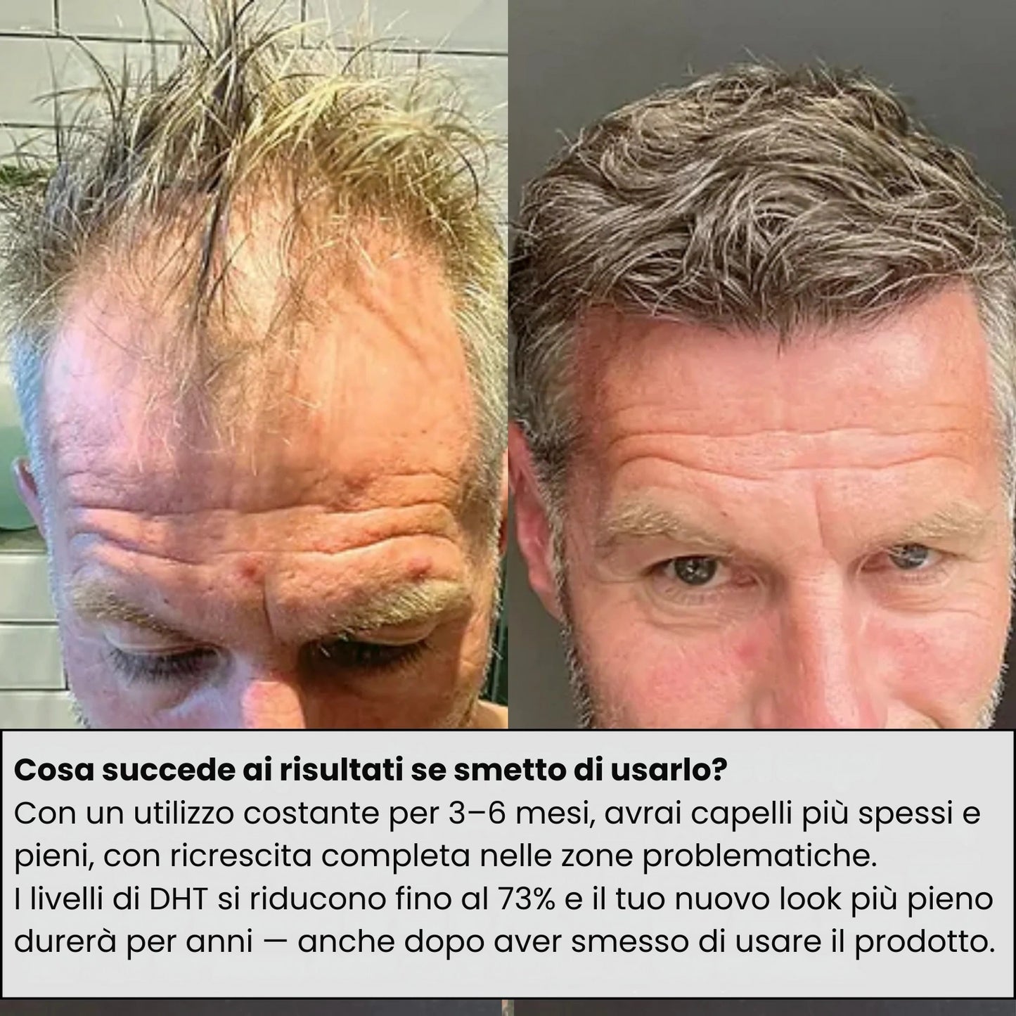 ApexInfuse™ Sistema di Ricrescita dei Capelli