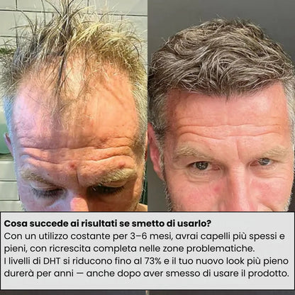 ApexInfuse™ Sistema di Ricrescita dei Capelli